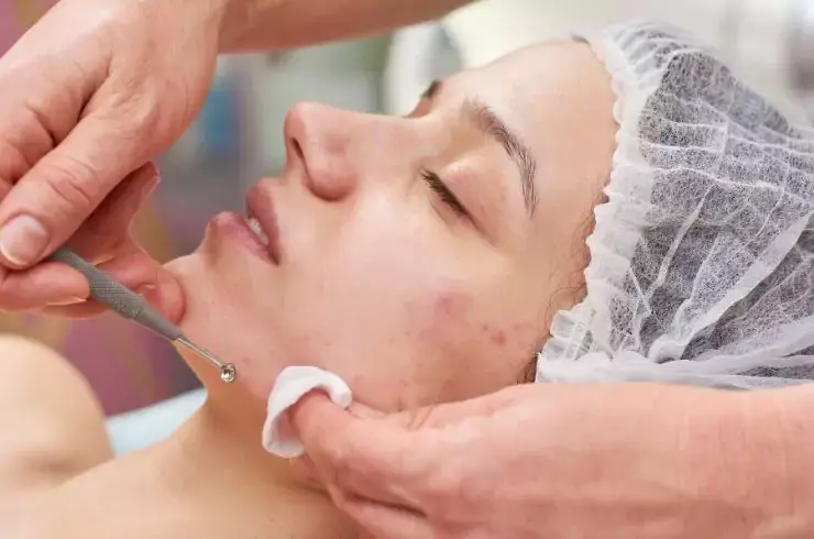 stardermclinic-acne-treatment