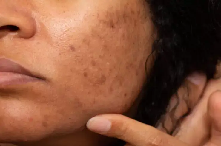 stardermclinic-pigmentation-and-dark-spot-removal-