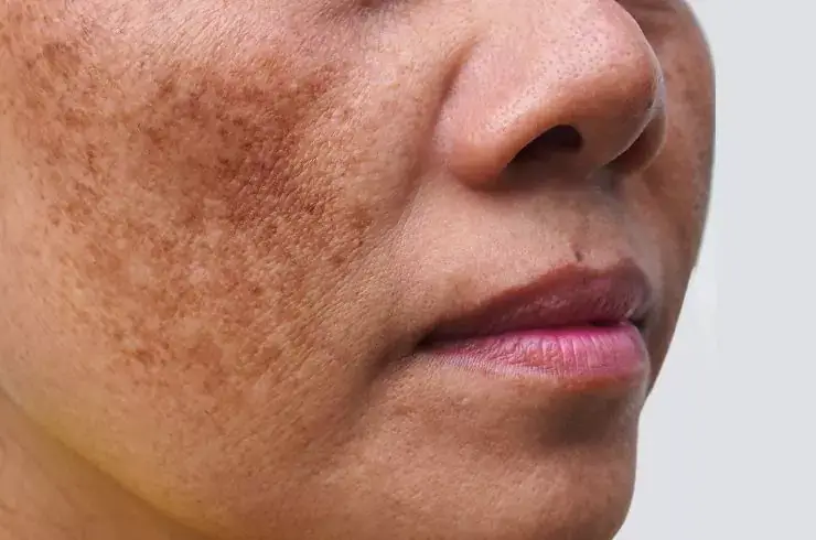 stardermclinic-pigmentation-and-melasma-treatment-