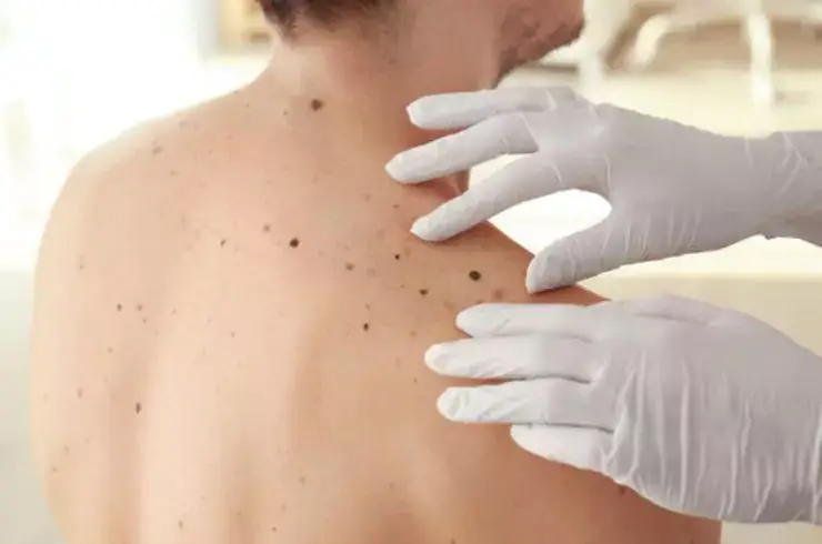 stardermclinic-skin-cancer-screening-and-management-