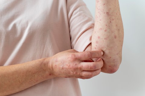 Know More About Eczema