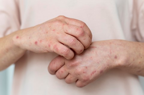 Eczema: A Common Skin Condition