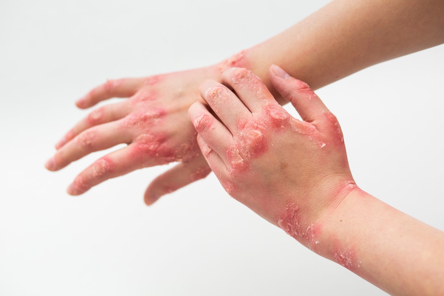 Everything You Should Know About Psoriasis