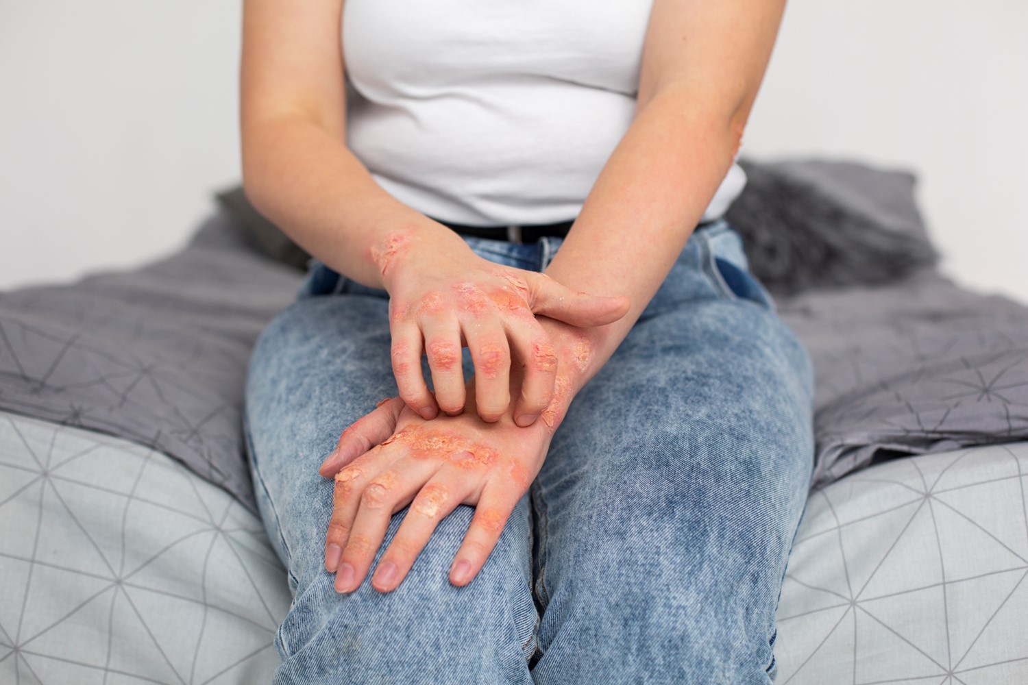 Living with Psoriasis: Coping Strategies and Support Resources