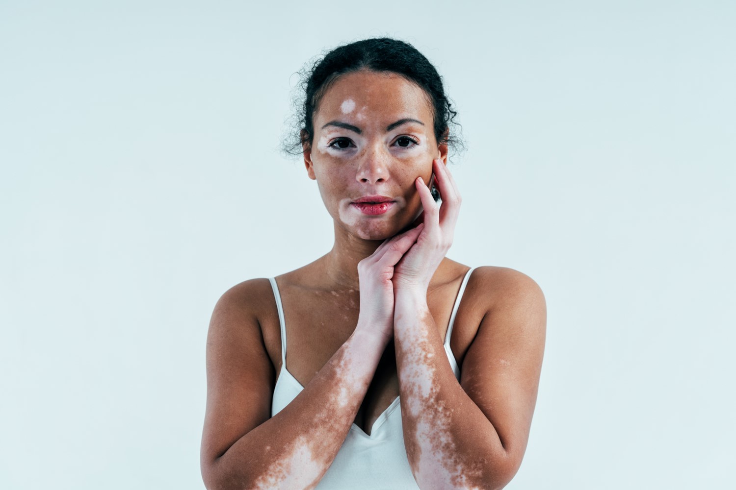 Vitiligo Treatment Options: A Comprehensive Guide